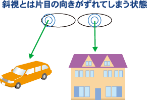 斜視とは片目の向きがずれてしまう状態